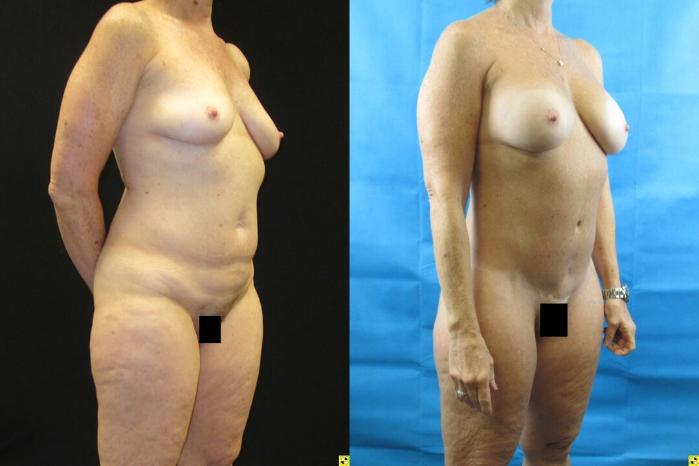 Before & After Tummy Tuck Case 94 View 2 View in Savannah, GA