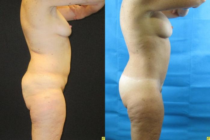 Before & After Tummy Tuck Case 94 View 3 View in Savannah, GA
