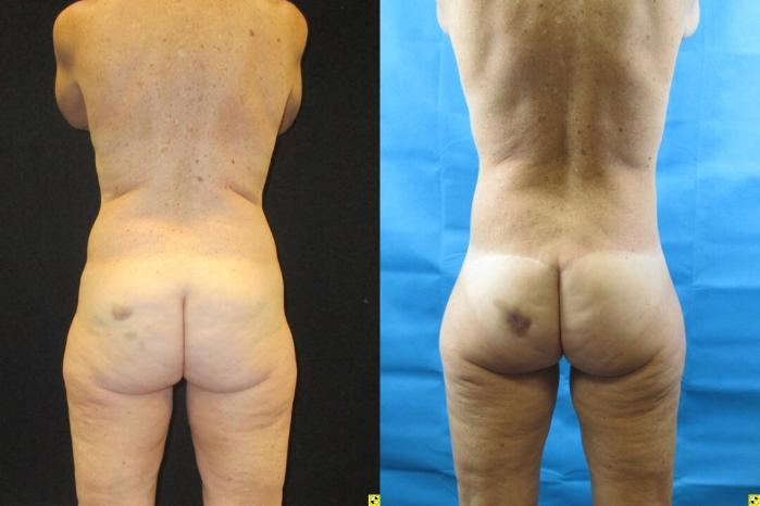 Before & After Tummy Tuck Case 94 View 4 View in Savannah, GA