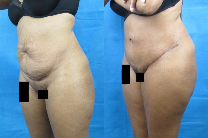 Before & After Tummy Tuck Case 98 View 2 View in Savannah, GA