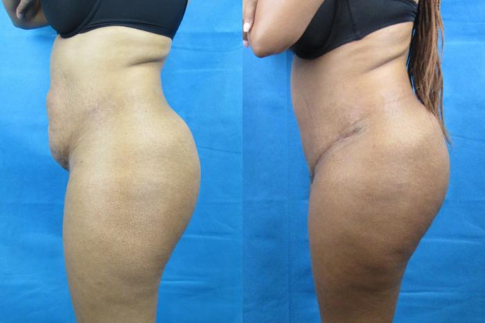 Before & After Tummy Tuck Case 98 View 3 View in Savannah, GA