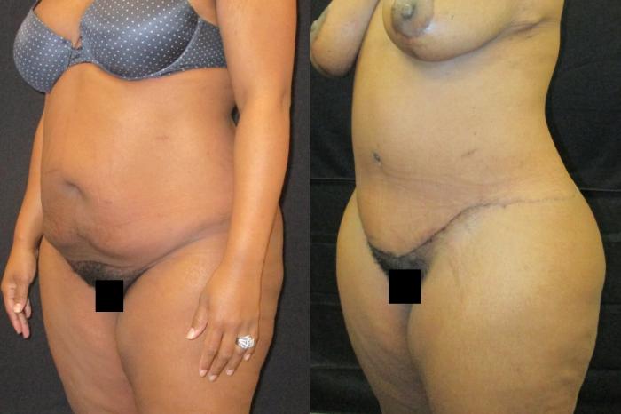 Before & After Tummy Tuck Case 99 View 2 View in Savannah, GA