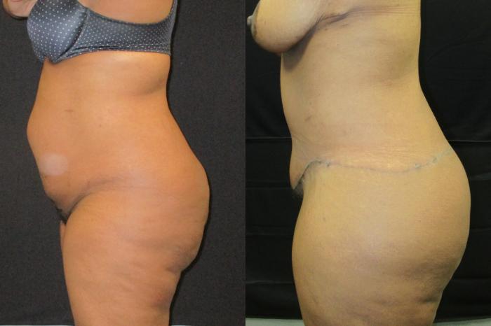 Before & After Tummy Tuck Case 99 View 3 View in Savannah, GA
