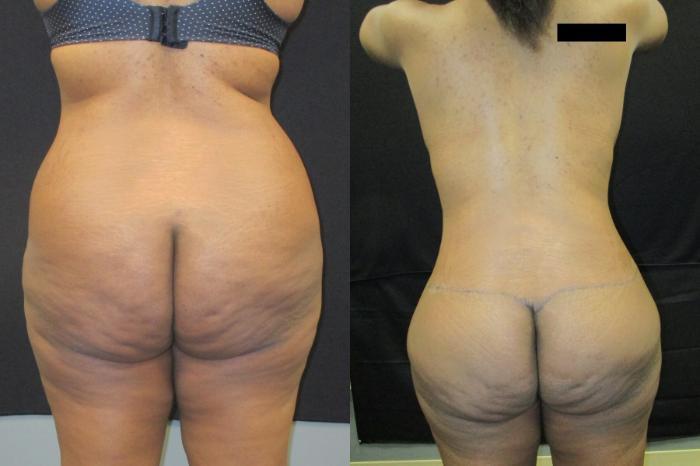 Before & After Tummy Tuck Case 99 View 4 View in Savannah, GA